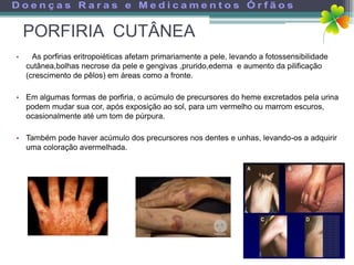 PORFIRIA CUTÂNEA
•     As porfirias eritropoiéticas afetam primariamente a pele, levando a fotossensibilidade
    cutânea,bolhas necrose da pele e gengivas ,prurido,edema e aumento da pilificação
    (crescimento de pêlos) em áreas como a fronte.

• Em algumas formas de porfiria, o acúmulo de precursores do heme excretados pela urina
  podem mudar sua cor, após exposição ao sol, para um vermelho ou marrom escuros,
  ocasionalmente até um tom de púrpura.

• Também pode haver acúmulo dos precursores nos dentes e unhas, levando-os a adquirir
  uma coloração avermelhada.
 