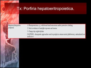 Tx: Porfiria hepatoeritropoietica.
 
