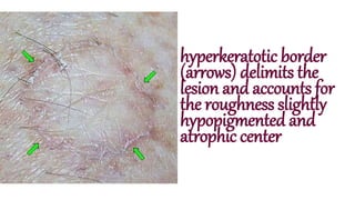 hyperkeratotic border
(arrows) delimits the
lesion and accounts for
the roughness slightly
hypopigmented and
atrophic center
 