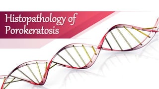 Histopathology of
Porokeratosis
 