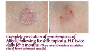 Complete resolution of porokeratosis of
Mibelli following Rx with topical 5-FU. twice
daily for 2 months (There are erythematous excoriation
sites of recent arthropod assaults)
 