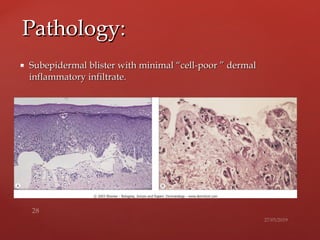  Subepidermal blister with minimal “cell-poor ” dermalSubepidermal blister with minimal “cell-poor ” dermal
inflammatory infiltrate.inflammatory infiltrate.
Pathology:Pathology:
 