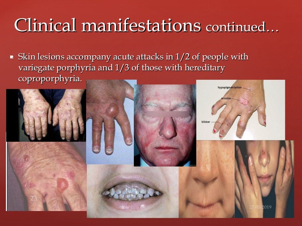 Porphyria