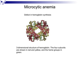 Microcytic anemia
Defect in hemoglobin synthesis
3-dimensional structure of hemoglobin. The four subunits
are shown in red and yellow, and the heme groups in
green.
 