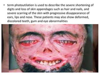 • term photoutilation is used to describe the severe shortening of
digits and loss of skin appendages such as hair and nails, and
severe scarring of the skin with progressive disappearance of
ears, lips and nose. These patients may also show deformed,
discolored teeth, gum and eye abnormalities
 