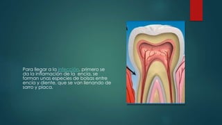 Para llegar a la infección, primero se 
da la inflamación de la encía, se 
forman unas especies de bolsas entre 
encía y diente, que se van llenando de 
sarro y placa. 
 