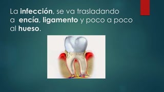 La infección, se va trasladando 
a encía, ligamento y poco a poco 
al hueso. 
 