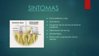 SINTOMAS 
 Encía brillante y roja. 
 Mal aliento. 
 Sangrado de las encías durante el 
cepillado. 
 Inflamación de encías. 
 Dientes flojos. 
 Retracción y separación de los 
dientes. 
 