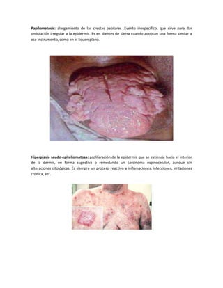 Papilomatosis: alargamiento de las crestas papilares .Evento inespecífico, que sirve para dar
ondulación irregular a la epidermis. Es en dientes de sierra cuando adoptan una forma similar a
ese instrumento, como en el liquen plano.

Hiperplasia seudo-epiteliomatosa: proliferación de la epidermis que se extiende hacia el interior
de la dermis, en forma sugestiva o remedando un carcinoma espinocelular, aunque sin
alteraciones citológicas. Es siempre un proceso reactivo a inflamaciones, infecciones, irritaciones
crónica, etc.

 
