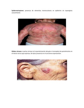 Epidermotropismo: presencia de elementos mononucleares en epidermis sin espongiosis
concomitante.

Globos córneos: o perlas corneas es la queratinización abrupta e incompleta de queratinocitos en
el interior de la capa espinosa. De típica presencia en el carcinoma espinocelular.

 