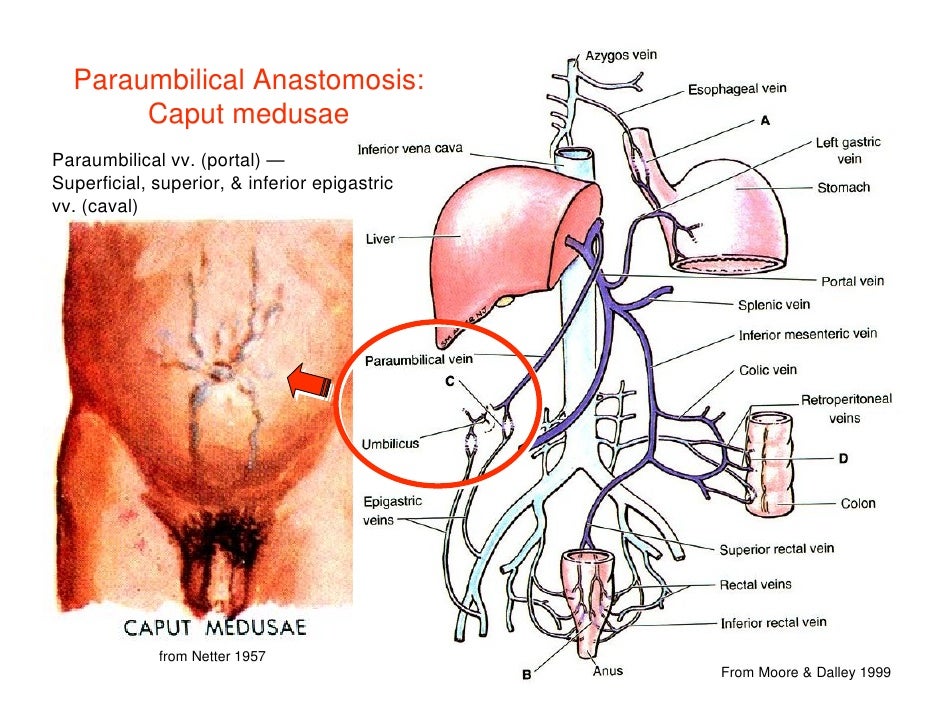 portacaval anastomosis
