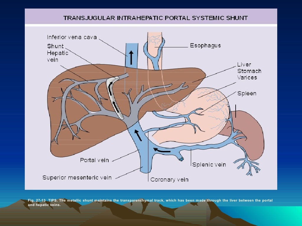 Portal Hypertension12