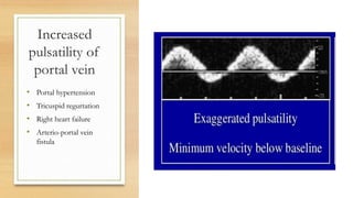 Increased
pulsatility of
portal vein
• Portal hypertension
• Tricuspid regurtation
• Right heart failure
• Arterio-portal vein
fistula
 