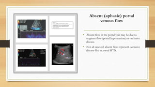 Absent (aphasic) portal
venous flow
• Absent flow in the portal vein may be due to
stagnant flow (portal hypertension) or occlusive
disease.
• Not all cases of absent flow represent occlusive
disease-like in portal HTN.
 