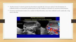 • Another feature of occlusive portal vein thrombosis (especially the non acute variety) is the development of
collateral vessels in or around the occluded portal vein; this condition is referred to as cavernous transformation.
• Cavernous transformation tends to be a marker for bland thrombus, since these collateral vessels usually take a long
time to develop.
 