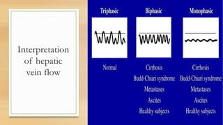 Interpretation
of hepatic
vein flow
 