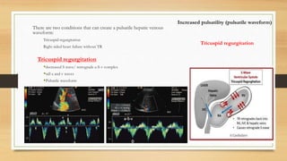There are two conditions that can create a pulsatile hepatic venous
waveform:
Tricuspid regurgitation
Right sided heart failure without TR
Tricuspid regurgitation
decreased S wave/ retrograde a-S-v complex
tall a and v waves
Pulsatile waveform
Increased pulsatility (pulsatile waveform)
Tricuspid regurgitation
 
