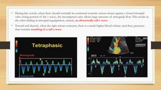 • During late systole, when there should normally be continued systemic venous return against a closed tricuspid
valve (rising portion of the v wave), the incompetent valve allows large amounts of retrograde flow. This results in
the other finding in tricuspid regurgitation, namely, an abnormally tall v wave.
• Toward end diastole, when the right atrium contracts, there is a much higher blood volume (and thus, pressure)
than normal, resulting in a tall a wave
 