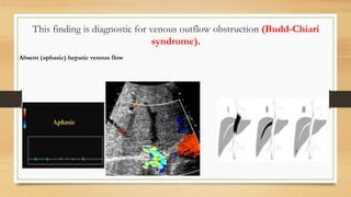 This finding is diagnostic for venous outflow obstruction (Budd-Chiari
syndrome).
Absent (aphasic) hepatic venous flow
 
