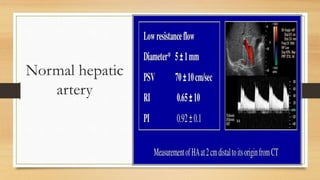 Normal hepatic
artery
 