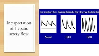 Interpretation
of hepatic
artery flow
 