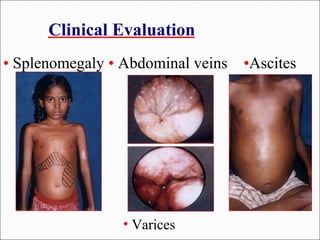 Clinical Evaluation
• Splenomegaly • Abdominal veins •Ascites
• Varices
 