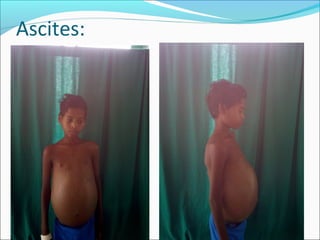 Ascites:
smalathi 23
 