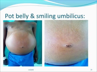 Pot belly & smiling umbilicus:
smalathi 24
 
