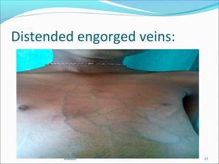 Distended engorged veins:
smalathi 25
 