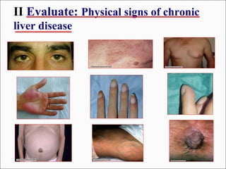 II Evaluate: Physical signs of chronic
liver disease
 