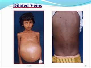 smalathi 32
Dilated Veins
 