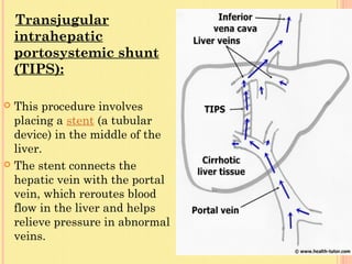 Tips Ct Portal hypertension, liver cirrhosis and liver transplant | PPT