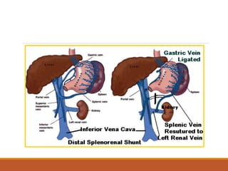 PORTAL HTN spleno renal shunt.ppt