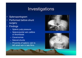 Investigations
• Splenoportogram
• Performed before shunt
  surgery
• Findings
   – Splenic pulp pressure
   – Splenic/por...