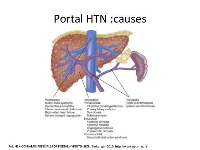 Portal Hypertension Natural Remedies Portal Hypertension Natural Remedies