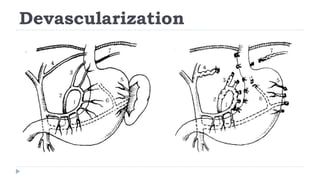 Portal Hypertension.ppt
