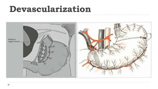Devascularization Portal Hypertension.ppt