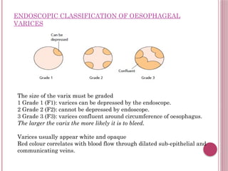 Jsph Varices Classification portal hypertension.pptx: Diagnosis and treatment | PPTX