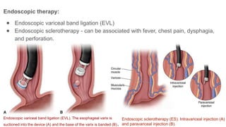 PORTAL HYPERTENSION : presentation, evaluation and management | PPTX