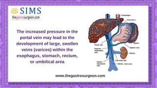 www.thegastrosurgeon.com
The increased pressure in the
portal vein may lead to the
development of large, swollen
veins (va...
