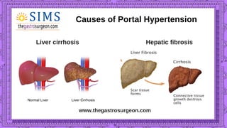 www.thegastrosurgeon.com
Causes of Portal Hypertension
Liver cirrhosis
 
Hepatic fibrosis
 