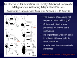 • The majority of cases did not
require an interposition graft
• Splenic vein ligation was
performed for tumors at the
confluence
• Re-implantation was only done
in patients with poor splenic
hylar collaterals
• Arterial resections ocassionally
performed
Yakebas et al. Annals of Surgery 2008
 
