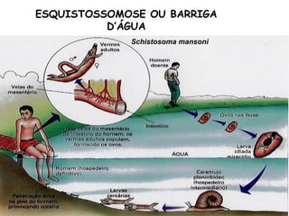 ESQUISTOSSOMOSE OU BARRIGA 
D’ÁGUA 
Schistosoma mansoni 
 