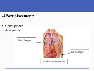 Port placement:
 Chest placed
 Arm placed
 