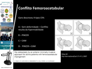 www.unidadedaanca.com 
Conflito Femoroacetabular 
Ganz descreveu 4 tipos CFA: 
A – Sem deformidade – Conflito 
resulta da hipermobilidade 
B – PINCER 
C – CAM 
D - PINCER + CAM 
Ribas M 
Hip International/vol 17 nº 2, 2007 
 