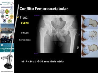 www.unidadedaanca.com 
Conflito Femoroacetabular 
Tipo: 
CAM 
PINCER 
Combinado 
M : F – 14 : 1  32 anos idade média 
 