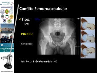 www.unidadedaanca.com 
Conflito Femoroacetabular 
Tipo: 
CAM 
PINCER 
Combinado 
M : F – 1 : 3  idade média ~40 
 