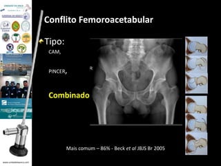 www.unidadedaanca.com 
Conflito Femoroacetabular 
Tipo: 
CAM, 
PINCER, 
Combinado 
Mais comum – 86% - Beck et al JBJS Br 2005 
 