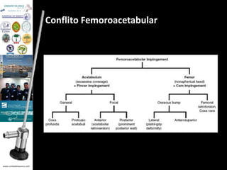 www.unidadedaanca.com 
Conflito Femoroacetabular 
 