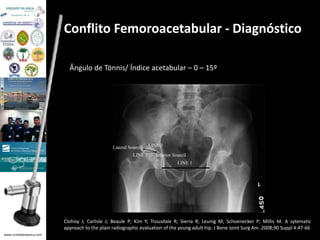 www.unidadedaanca.com 
Conflito Femoroacetabular - Diagnóstico 
Ângulo de Tönnis/ Índice acetabular – 0 – 15º 
Clohisy J; Carlisle J; Beaule P; Kim Y; Trousdale R; Sierra R; Leunig M; Schoenecker P; Millis M. A sytematic 
approach to the plain radiographic evaluation of the young adult hip. J Bone Joint Surg Am. 2008;90 Suppl 4:47-66 
 